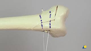 Femur Distal—Epiphyseal Fracture—Fixation Using Two Selfdrilling Selftapping Cannulated Screws [upl. by Antebi]