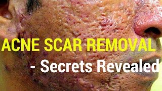 How to treat acne scars Dermatology Secrets revealed [upl. by Helsie]