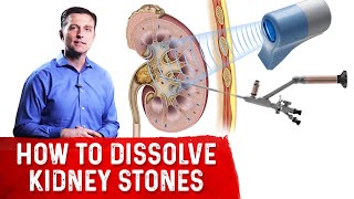 How To Dissolve Kidney Stones Explained By DrBerg [upl. by Ponzo]