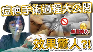 終極的痘疤治療！凹痘疤消失的一線生機！帶你一起解密真皮移植實境秀！ [upl. by Deva719]