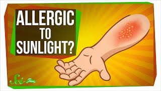 Can You Be Allergic To Sunlight [upl. by Viens]