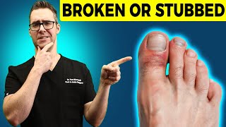 Stubbed Toe or Broken Toe Symptoms Pain Relief amp Treatment [upl. by Vershen]