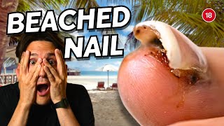 Toenail Removal After Beach Injury StepbyStep Procedure amp Care Tips [upl. by Hale]