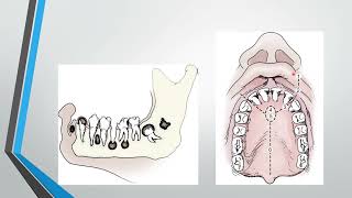 Cysts of the maxillofacial region [upl. by Krell]