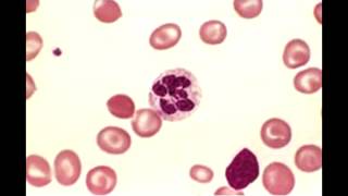 Megaloblastic Anemia  Macrocytic Anemia overview [upl. by Howzell]