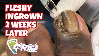 Fleshy Ingrown Toenail Removal 2 Weeks Later [upl. by Ong]