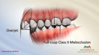 Malocclusion  Class II Div I [upl. by Irafat464]