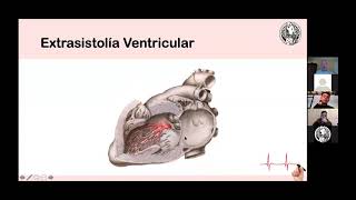10 Fibrilación Auricular Flutter y Extrasístoles Dr Christian Karmelic 2021 [upl. by Ennazor]