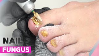 Onychomycosis  How to Deal with Nail Fungus [upl. by Pomona]