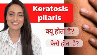 Keratosis Pilaris Treatment  Causes  Precautions  How to improve  Dermatologist recommends [upl. by Alicul]