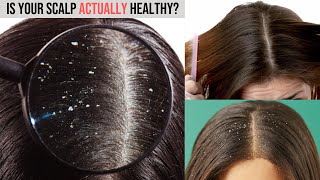 How to Treat Dandruff Dermatitis or Scalp Psoriasis  Causes Symptoms and Treatments [upl. by Dugald]