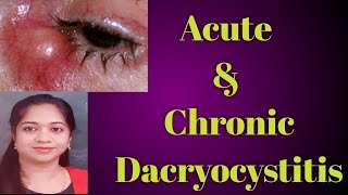 Dacryocystitis  Acute dacryocystitis Chronic Dacryocystitis Stages of Dcryocystitis Mucocele [upl. by Geithner]