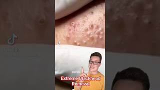 EXTREME BLACKHEAD REMOVAL  Blackhead Popping At Its Best shorts [upl. by Alphonso]