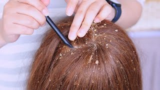 Dandruff Removal with Herbal Materials  Satisfying ASMR [upl. by Leff82]