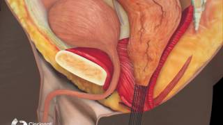 Surgical Treatment of Bulbar Urethral Fistula  Cincinnati Childrens [upl. by Adyela467]