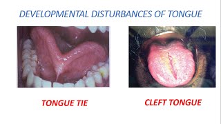 Tongue tie  Ankyloglossia and Cleft tongue [upl. by Bevvy]