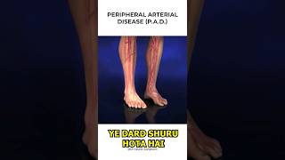 Claudication In Legs Symptoms  Claudication  Leg Pain  Dr Gaurav Gangwani [upl. by Julita]