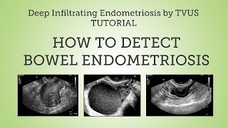 Deep Infiltrating Bowel Endometriosis Detection by TVUS Tutorial [upl. by Nerred]