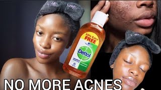 How To Use DETTOL Antiseptic Liquid to clear pimples and black spots [upl. by Laohcin]