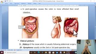 Intestinal disorders in Arabic 6  Paralytic ileus   by Dr Wahdan [upl. by Nathalia]