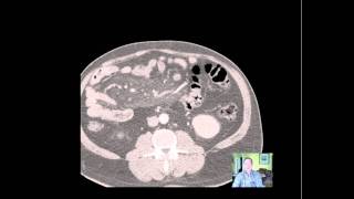 Sclerosing Mesenteritis CTmp4 [upl. by Aimat584]