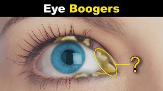 What Are Eye Boogers  Eye Discharge Rheum In Eyes [upl. by Janina]