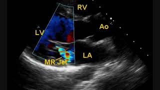 Post BMV Echocardiogram [upl. by Ailedroc]