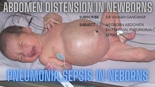 Abdominal Distension In Neonates  Pneumonia In Neonates  Sepsis In Newborn  Neonates In NICU [upl. by Silletram]