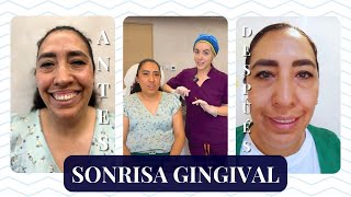 SONRISA GINGIVAL BÓTOX para dejar de mostrar las ENCÍAS al SONREÍR I MARISOL GÓNGORA [upl. by Waylin]