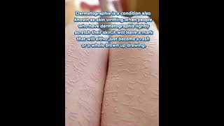 what is dermatographia ytshorts knowledge youtubeshorts [upl. by Ylrebmi]