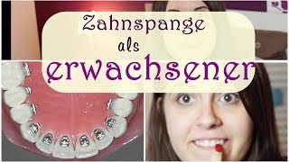 Zahnspange bei erwachsenen  Lingualtechnik  Kosten  JuMarie [upl. by Boycey]