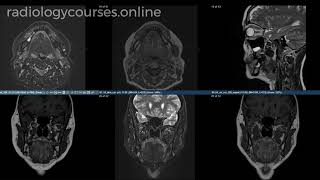 Osteonecrosis of the mandible [upl. by Narcis471]