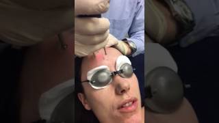 Erbium Yag Laser Treatment using Asclepion MCL31 Dermablate [upl. by Uno]