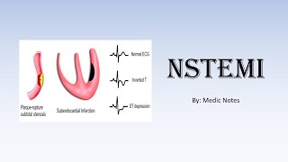 NSTEMI nonST elevation myocardial infarction  investigations management [upl. by Jelena]