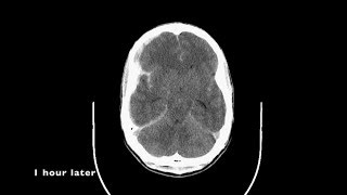 Posterior comunicating artery aneurysm Embolization [upl. by Arad174]