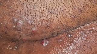 Satisfying Ingrown Hair Removal Back of head  Pt 3 [upl. by Digirb]