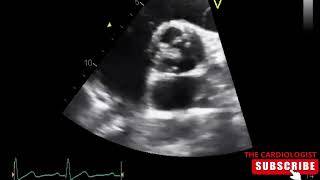 Bicuspid Aortic Valve with raphe [upl. by Ztirf418]