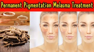 Permanent Pigmentation Removal At HomeHow To Remove Dark Spots [upl. by Massey]