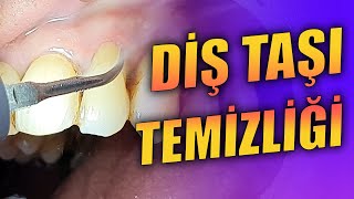 Diş Taşı Temizliği ve Kök Yüzeyi Düzleştirmesi [upl. by Ednutey716]