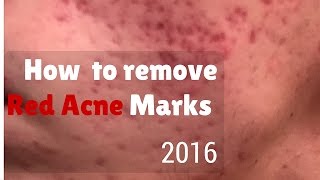 How to remove red marks from acne [upl. by Jacey]