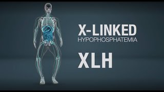 Xlinked hypophosphatemia XLH mechanism of disease [upl. by Rivi]