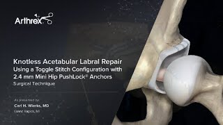 Knotless Acetabular Labral Repair Using a Toggle Stitch Configuration with 24 mm Mini Hip PushLock® [upl. by Nuahsyt]