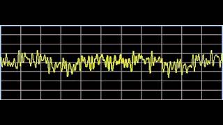 Eyelid Droop Ptosis  Rife Frequencies [upl. by Talich456]