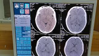 How CT Scan Of Brain Can Be Done  Full Work Process  For RadiographerMedical Technologist  GE CT [upl. by Ellirehs]