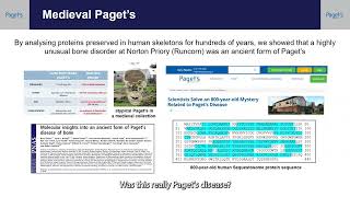 Historical Pagets Disease of Bone [upl. by Michaella]