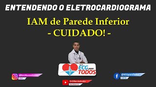 Infarto Agudo do Miocárdio de Parede Inferior  CUIDADO [upl. by Page998]