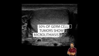 Testicular microlithiasis Should we worry [upl. by Beisel]