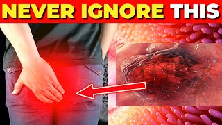 Critical Colon Cancer Symptoms You Should Never Ignore [upl. by Nitaj]