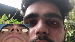 How To Reshape Nose Bone Naturally  Get Sharp and Straight Nose in 14 minutes [upl. by Idnat894]