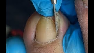 Huge ingrown toenail removal [upl. by Rolo]